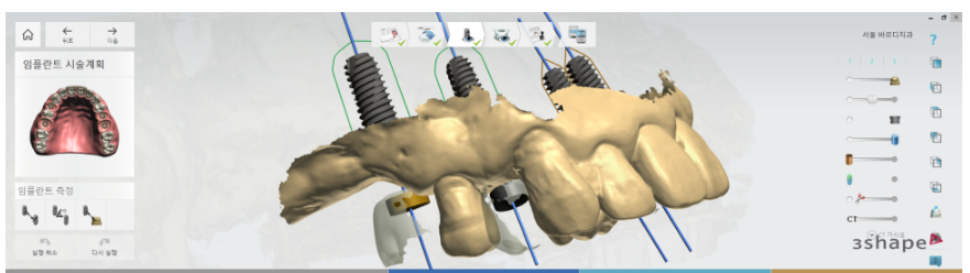 천호동 임플란트 앞니가 왜 어렵다는거죠? 수술이 안된다는데... 관련 이미지 4