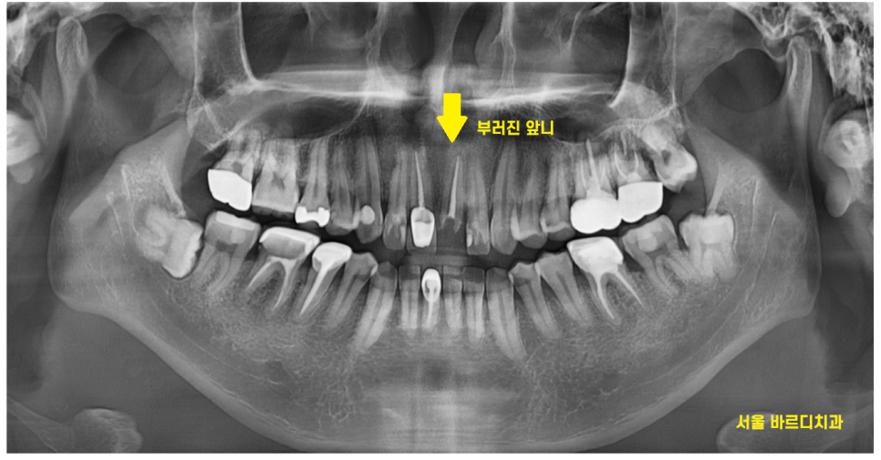앞니 부러짐 손상이 커서 하남선동치과에서 임플란트 치료 관련 이미지 4