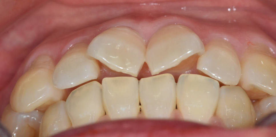 나비 모양 앞니 2가지 방법으로 개선 가능합니다. 관련 이미지 5