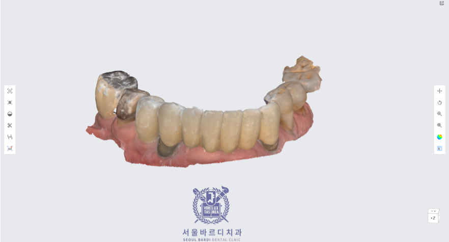 고덕동치과 서울바르디치과 전치부 및 구치부 임플란트 치료증례 #10 관련 이미지 6