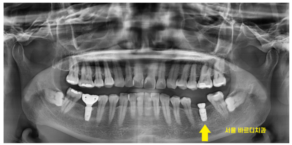 고덕역 근처 치과 임플란트 크라운 크기 크면 다 좋을까요?? 관련 이미지 5
