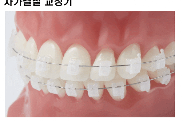 치아 교정기 종류 결정장애 환자분들을 위한 친절한 설명서 관련 이미지 1