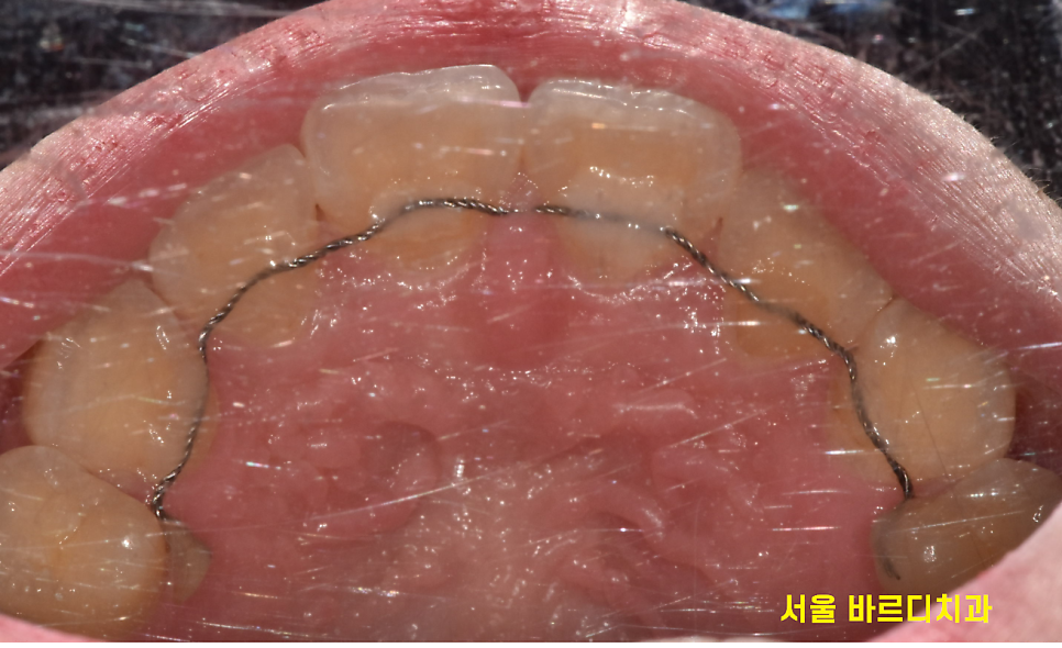 치과 유지장치 떨어짐 언제까지 하고 있어야하나요? 관련 이미지 1