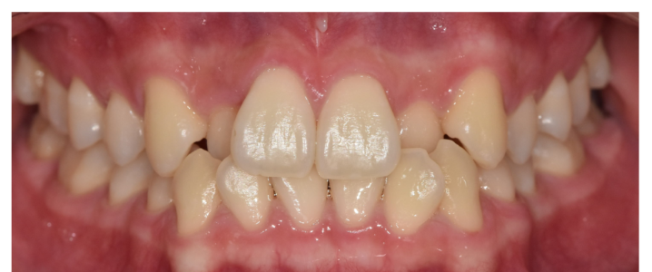 고덕동 교정 치과 성인 덧니 교정 지금도 늦지 않았습니다. 관련 이미지 2
