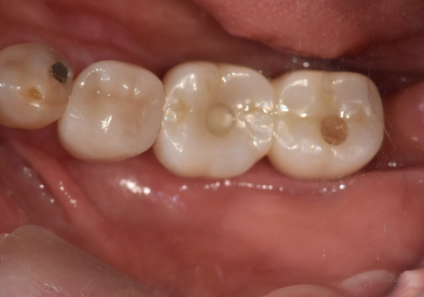 Sangil-dong Station Implant Visits: How Many Times Do You Actually Need to Go to the Dentist? image 10