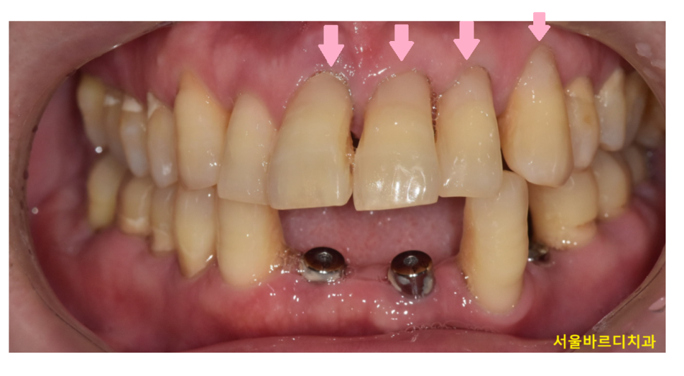 치아 옆면 파임 치경부마모증 치료해주어야하는 이유는? 관련 이미지 5