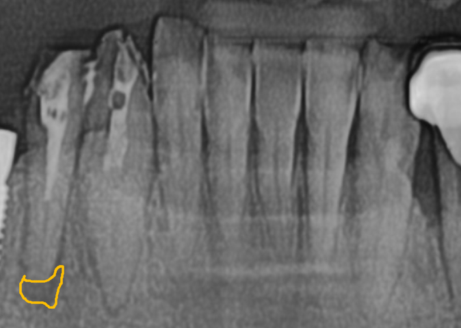 강동구 치아 뿌리 염증, 신경치료 한 치아인데도 아플 수 있나요? 관련 이미지 1