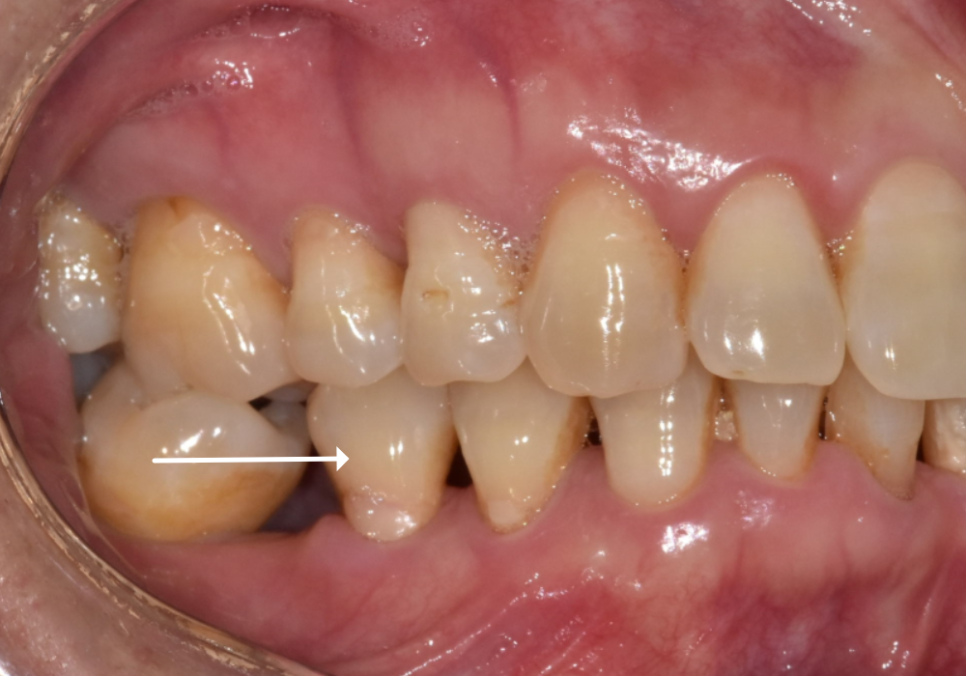 발치 후 빈 공간, 이 빼고 오래 냅두면 이렇게 됩니다. 관련 이미지 2