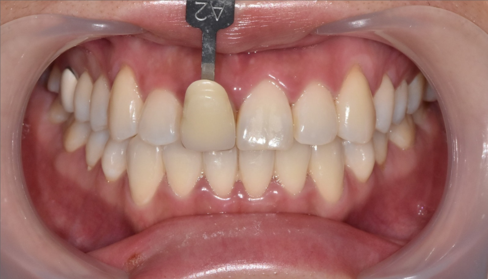 강동구 치아 미백 과정 확인하고 환한 미소로 웃어봐요 우리 관련 이미지 6