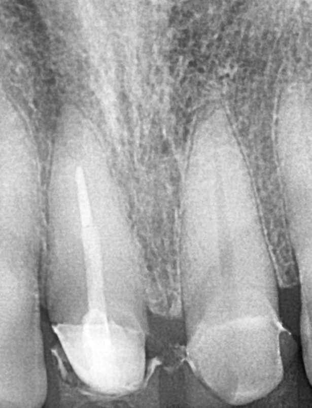 앞니 금 갔을 때, 방치하면 안 되는 진짜 이유 <파절 치료 사례> 관련 이미지 10