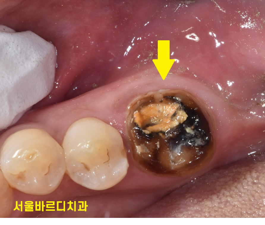 신경치료 염증 치아 다시 한번 치료하여 자연치아 살렸습니다. 관련 이미지 6