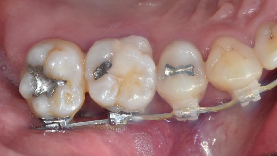 교정 중 충치 치료 먼저? 계속 방치? 알려드립니다. 관련 이미지 2