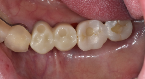 명일동 치과 임플란트 치료 기간 얼마나 걸릴까요??? 관련 이미지 11