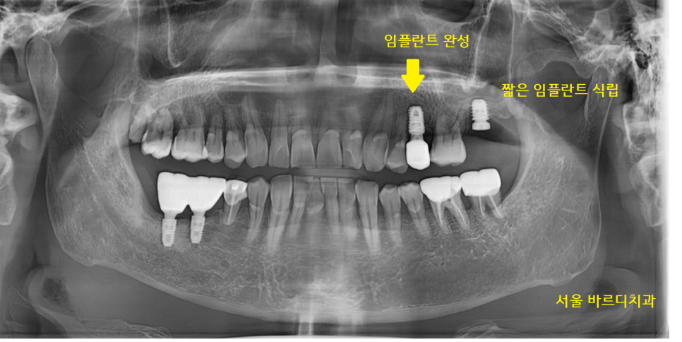 덕풍동 치과 임플란트 불가 판정받으신 환자분 살렸습니다. 관련 이미지 7