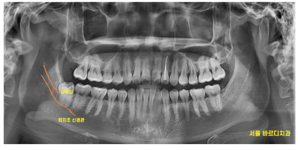 상일동 사랑니 맨날 뽑아야지는 그만!! 매복 치아도 깔끔하게 뽑으세요 관련 이미지 3
