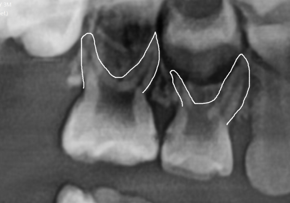 흔들리는 성인 잔존 유치, 50년 만에 송곳니 임플란트 하게 된 사연 관련 이미지 2
