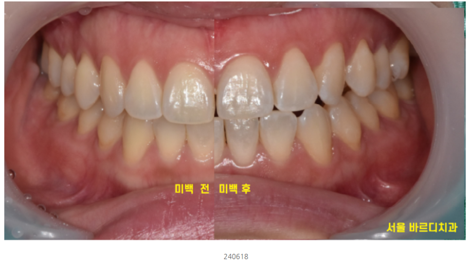 누런니 라미네이트와 미백중 뭐가 더 좋을까요?? 암사동 치과 관련 이미지 3