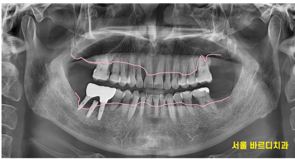 잇몸 고름 냄새 약으로 없앨 수는 없나요? 무시 무시한 치주염 관련 이미지 2