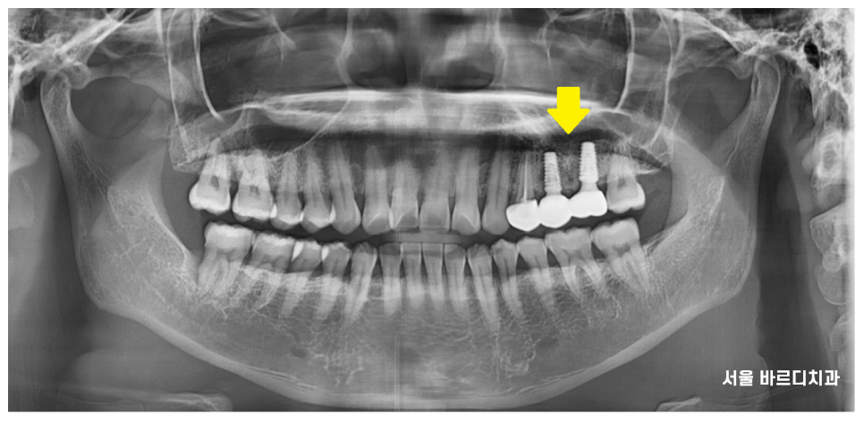 덕풍동 치과 씹을때 통증 임플란트로 극복했습니다. 관련 이미지 10