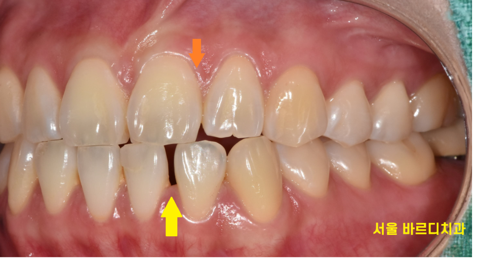벌어진 아래 앞니 라미네이트로 감쪽같게 치료했습니다. 관련 이미지 3