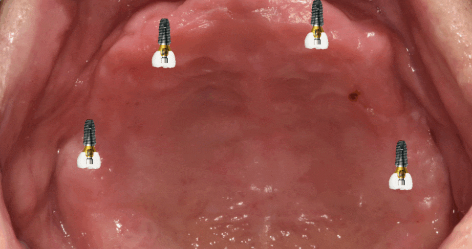 고덕역 치과 전체 치아 상실 시 자석 틀니 오버덴쳐가 해답이 될 수 있습니다. 관련 이미지 1