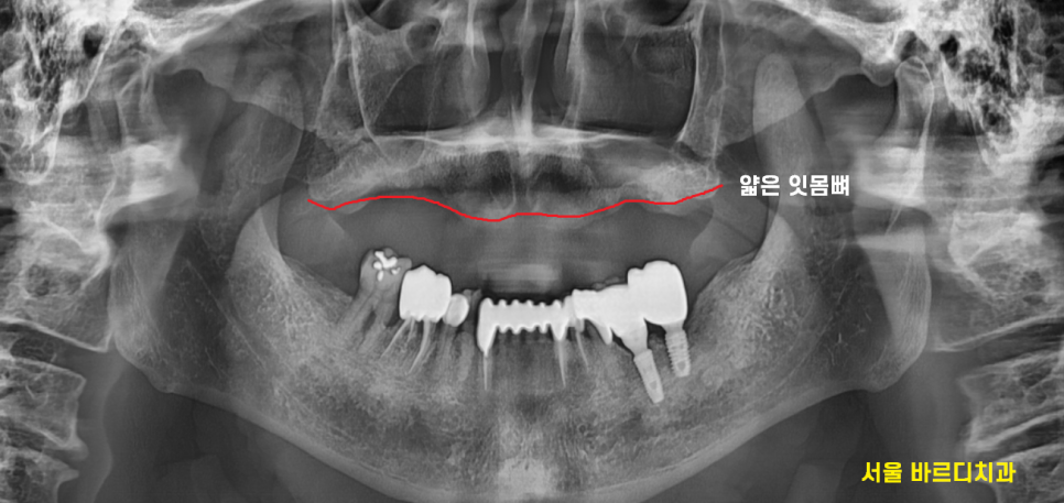 고덕역 치과 전체 치아 상실 시 자석 틀니 오버덴쳐가 해답이 될 수 있습니다. 관련 이미지 3