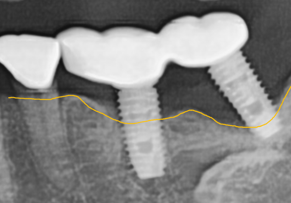 천호동 임플란트 재식립 사례, 평생 쓰는 줄 알았는데? 관련 이미지 3