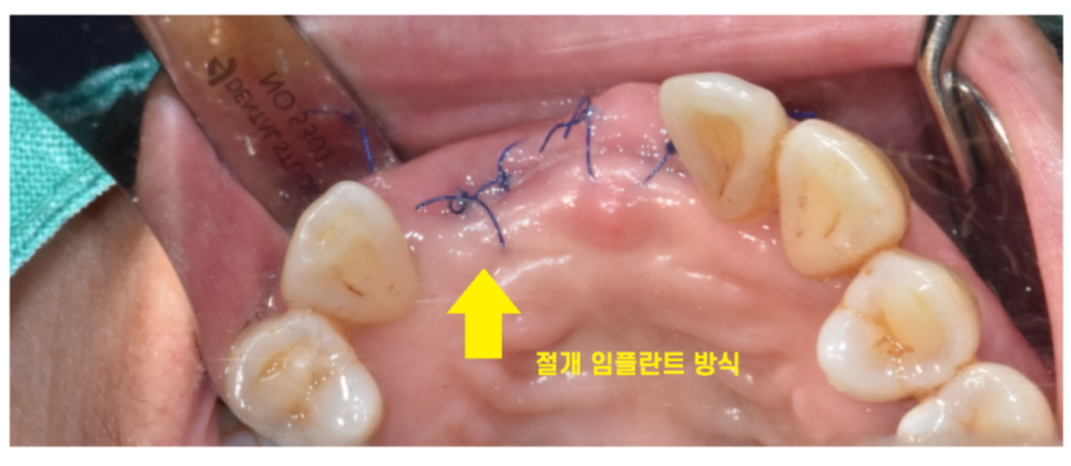 임플란트 실밥 언제 빼나요? 꺼끌거려서요 관련 이미지 3