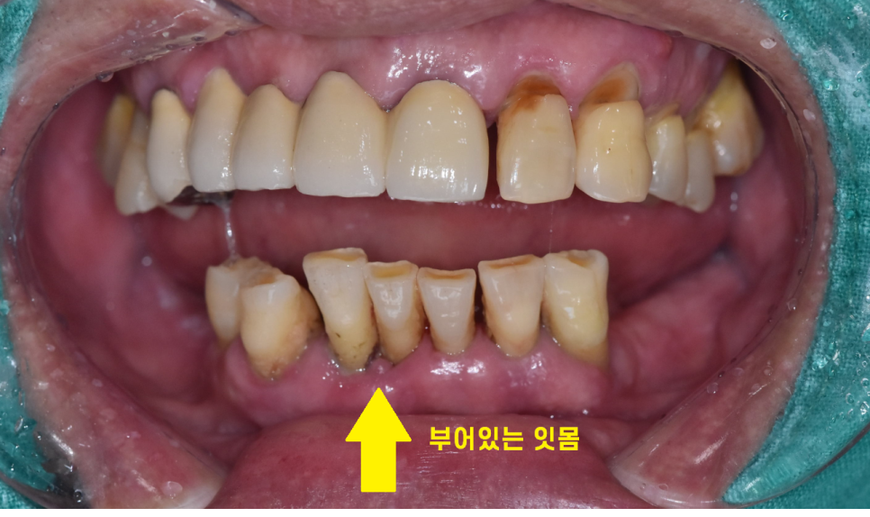 고덕 치과 잇몸 무너짐 천천히 진행되어서 더 무섭다. 관련 이미지 5