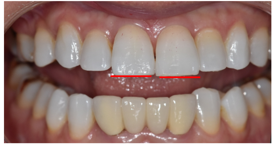 Solved My Concerns About Protruding Front Teeth with Partial Re-orthodontic Treatment of the Front Teeth image 4
