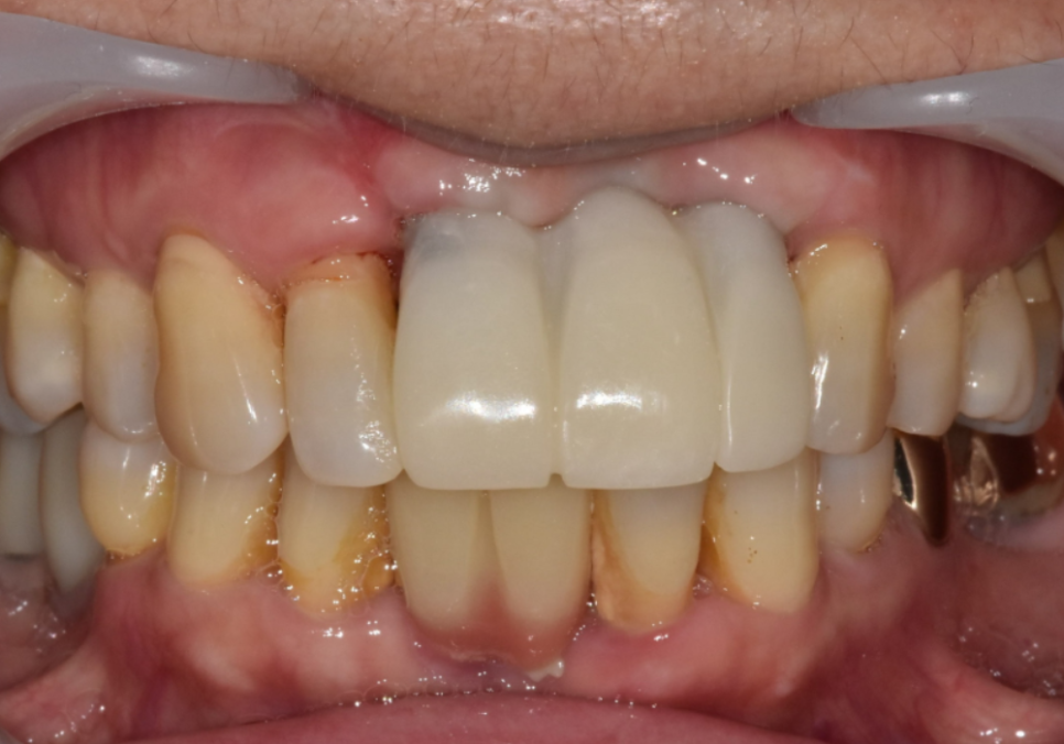 고덕동 임플란트, 튀어나온 앞니, 비용은 줄이고 자연스럽게 개선한 실제 사례 관련 이미지 14