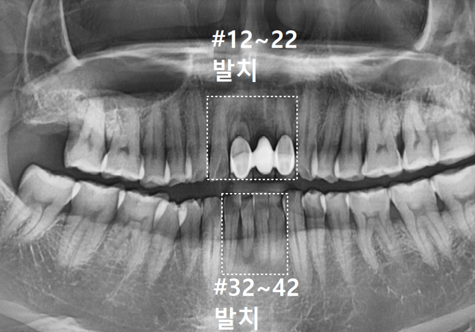 강일역 치과, 위 아래 앞니 임플란트 기간, 얼마나 걸리나요? 관련 이미지 12