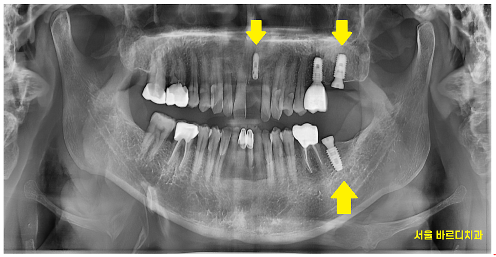 강동구 임플란트 위 아래 어금니 동시 식립으로 치료기간 대폭 축소 관련 이미지 6