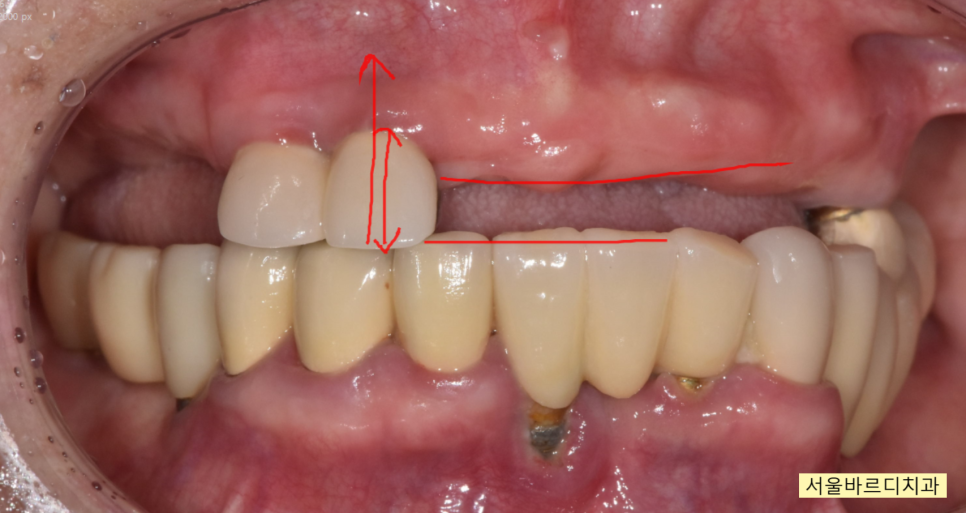 상일동 치과 부분 틀니에서 임플란트 바꿔서 사용하기 관련 이미지 3