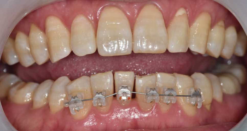 교정은 어릴 때 해야 한다? 성인과 청소년 교정, 뭐가 다를까? 관련 이미지 5