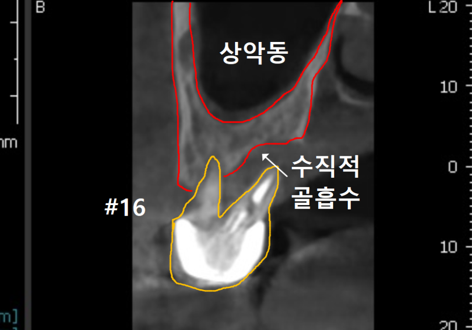 상악동 거상술 부작용 걱정되시나요? 재수술 없는 뼈이식의 정석 공개 관련 이미지 7