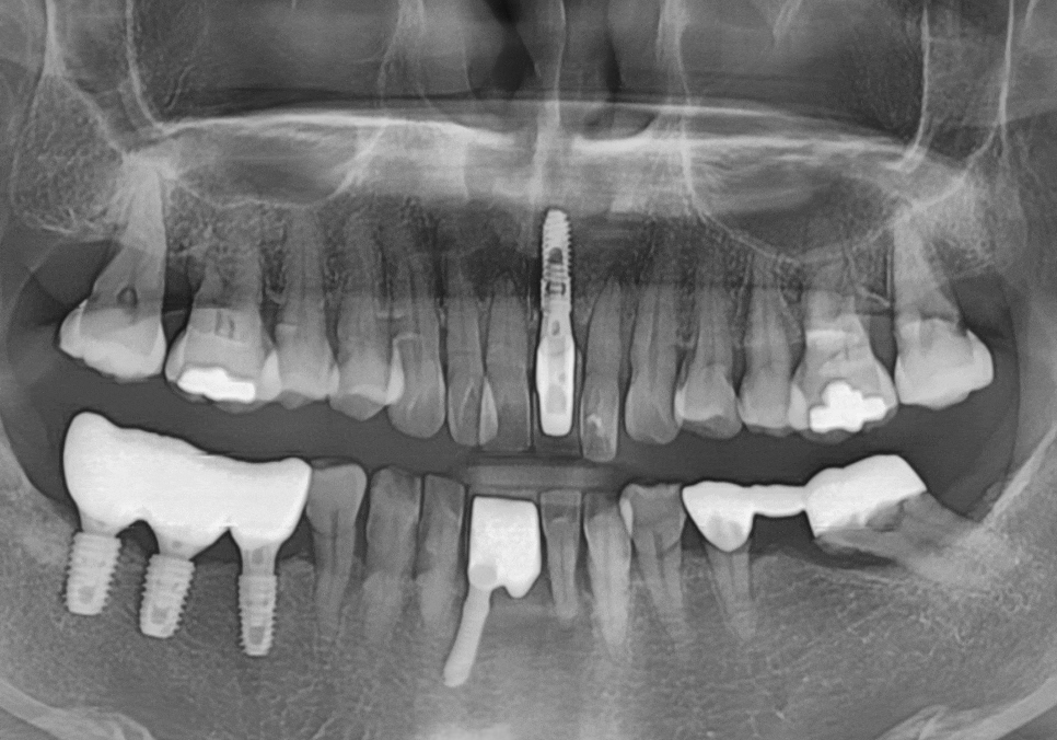 고덕동 임플란트, 튀어나온 앞니, 비용은 줄이고 자연스럽게 개선한 실제 사례 관련 이미지 16