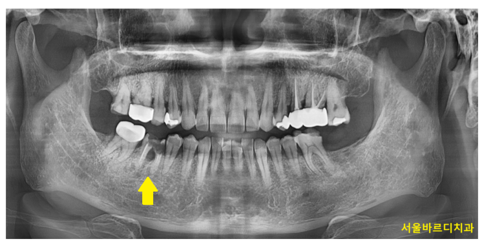 발치후 임플란트 시기 기다려야할까 바로 해야할까? 관련 이미지 1