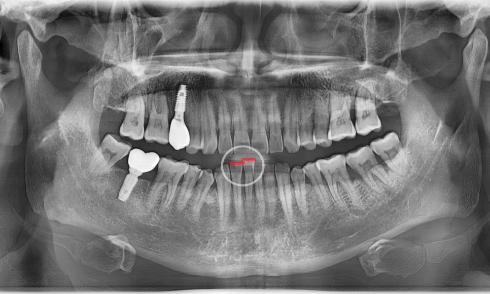 My Teeth Are Shaking So Much That Eating Is Uncomfortable—Is It Okay to Just Leave Them Alone? image 1