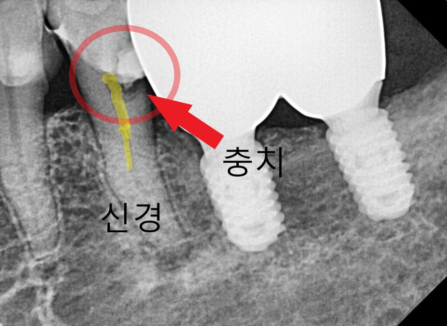 고덕동치과 임플란트 정기검진, 미루다가 수십만 원 손해 봅니다. 관련 이미지 5