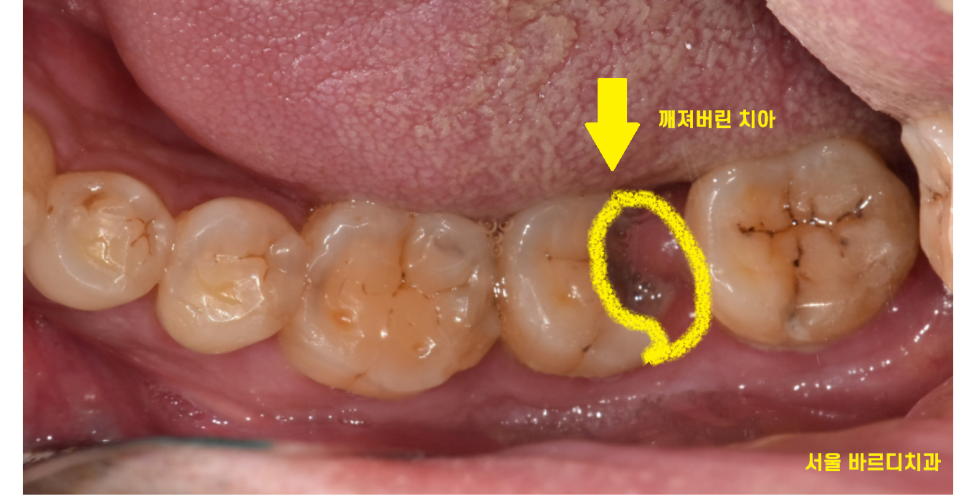 천호동 치과 충치로 인하여 손상된 치아 임플란트로 대처하기 관련 이미지 2