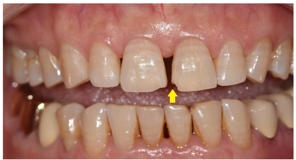 깨지고 벌어진 앞니 사이 레진으로 공간 재분배하였습니다. 관련 이미지 2