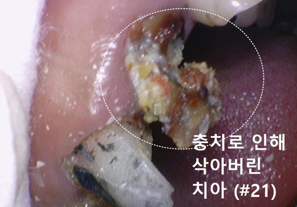 강동구 오래된 보철, 교체 시기는? 아프지 않은데 꼭 바꿔야 하나요? 관련 이미지 14