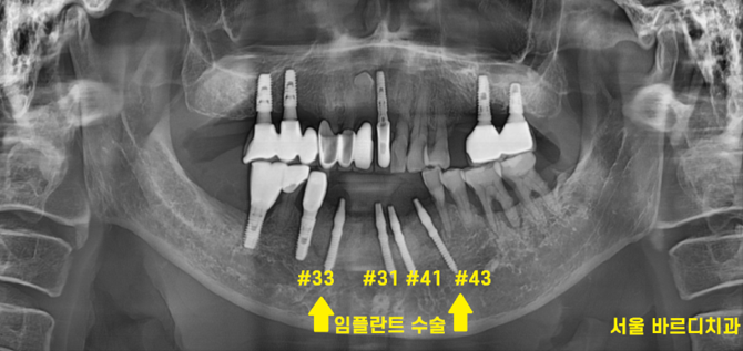 강동구 치과 앞니 흔들림 임플란트 케이스 관련 이미지 5