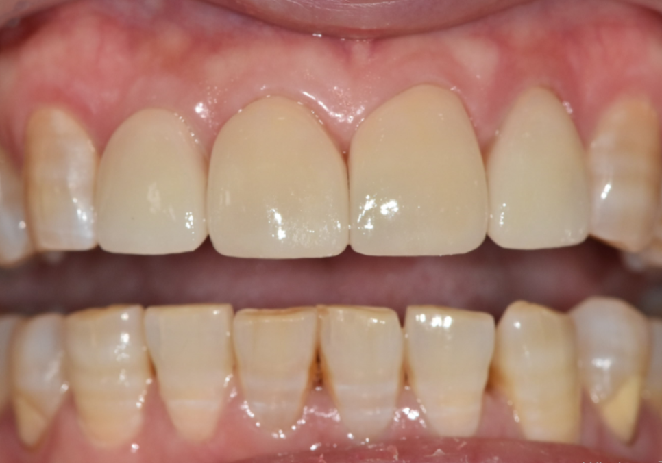50대 라미네이트, 앞니 벌어짐과 변색 고민 이렇게 해결했습니다. 관련 이미지 7