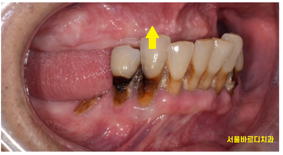 틀니 쓰다가 임플란트 어려움은 ? 높이를 높여주는게 킥!!! 관련 이미지 4