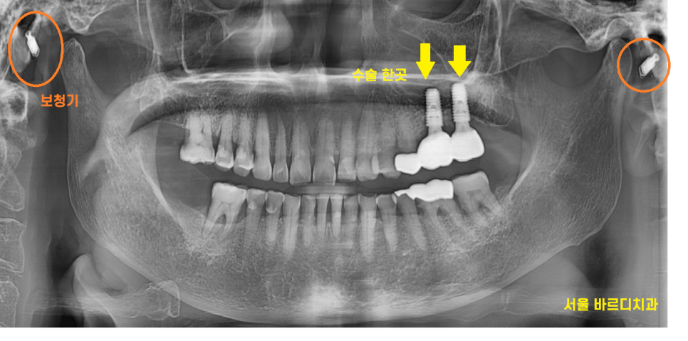 고덕동 치과 임플란트 거부감이 있었지만 네비게이션 수술법으로 해결했습니다. 관련 이미지 11