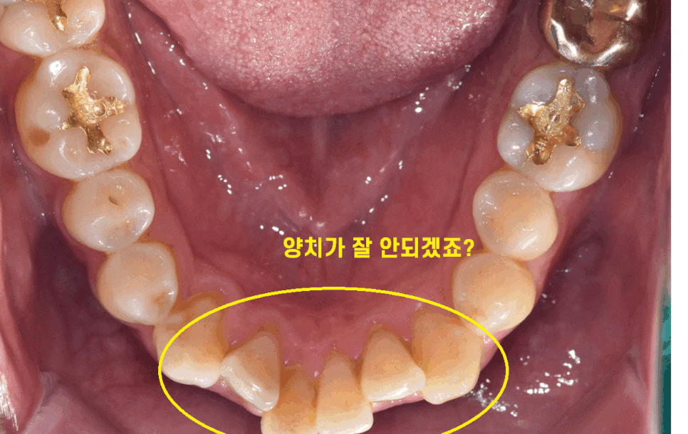 고덕역 교정치과 40대인데 치아 교정 가능한가요? 관련 이미지 1