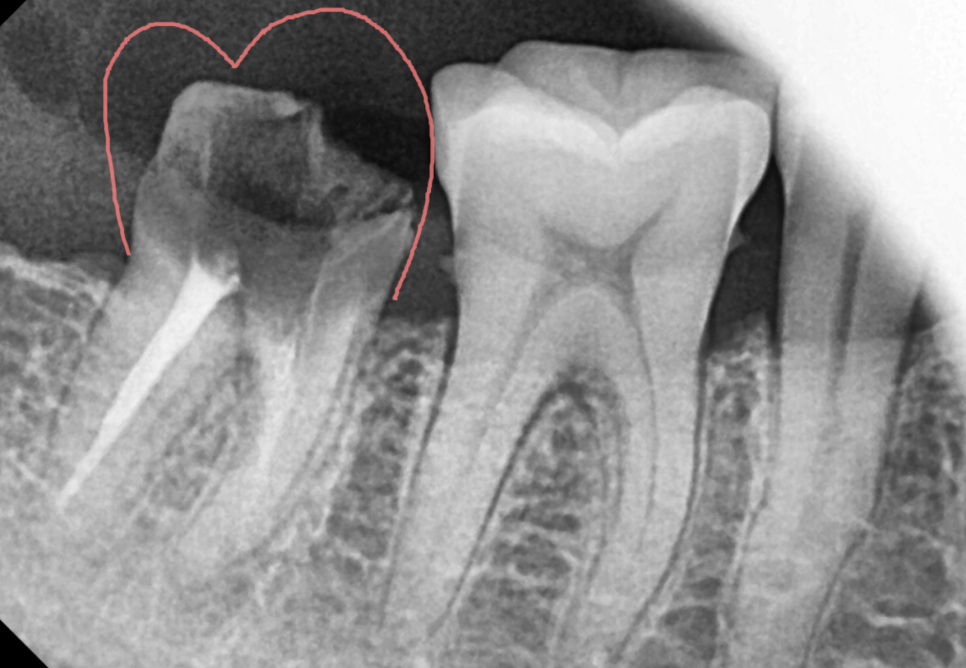 치아 크라운 빠짐 내부 충치가 심할때는 임플란트가 필요합니다. 관련 이미지 2