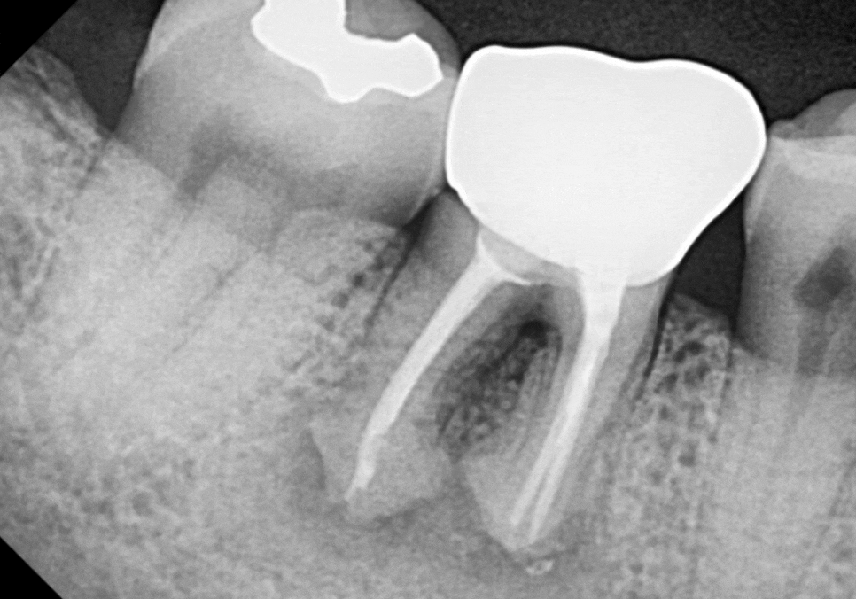 고덕역 임플란트, 뼈이식 꼭 해야 할까? 필수 상황 vs 제외 상황 총정리 관련 이미지 7